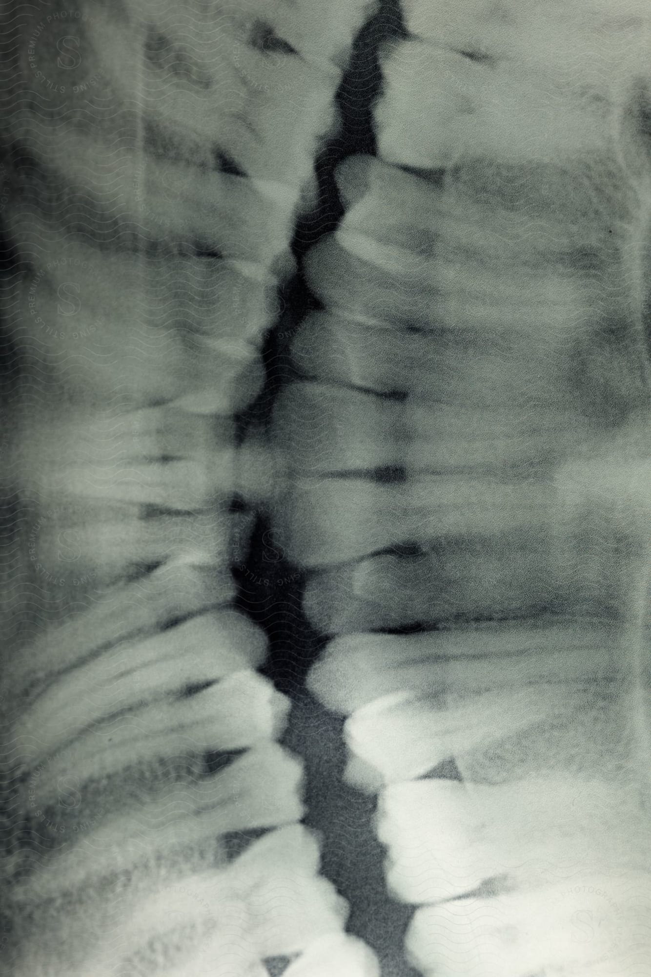 Verruca Treatment